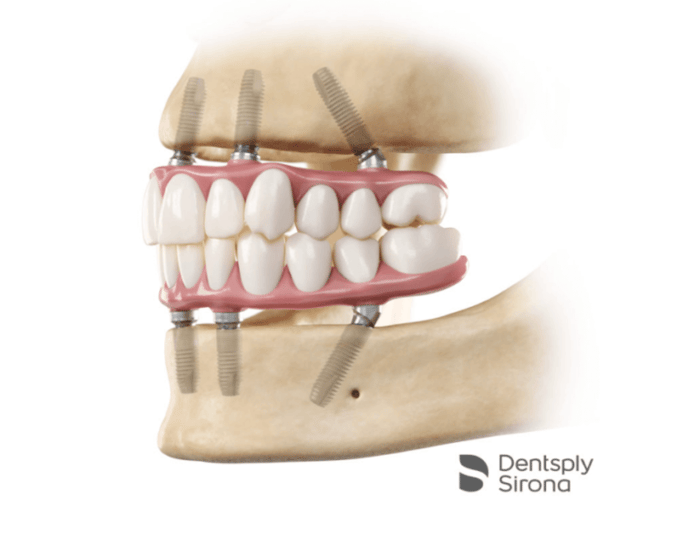 Visualisierung von Implantaten | Dentsply Sirona